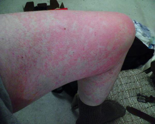 cold weather rash #11